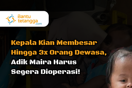 Kepala Kian Membesar Hinggal 3x Orang Dewasa, Adik Maira Harus Segera Dioperasi!